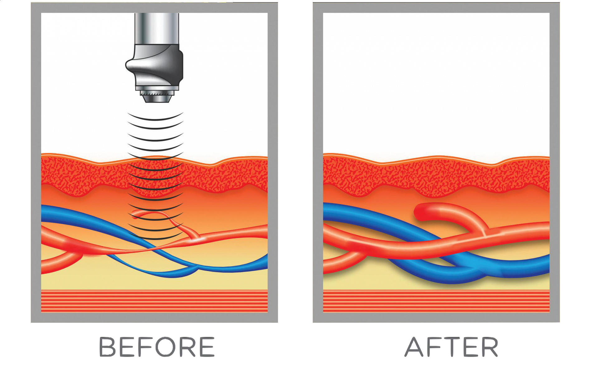 describing what shock wave therapy does to help reduce erectile dysfunction symptoms